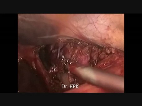 Thoraco-Laparoscopic Oesophagectomy