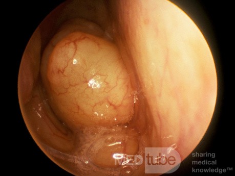 Left Septal Choanal Polyp Occluding the Right Choana