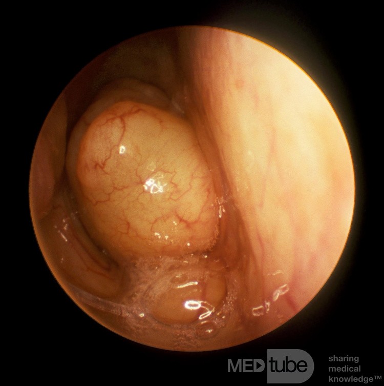 Left Septal Choanal Polyp Occluding the Right Choana