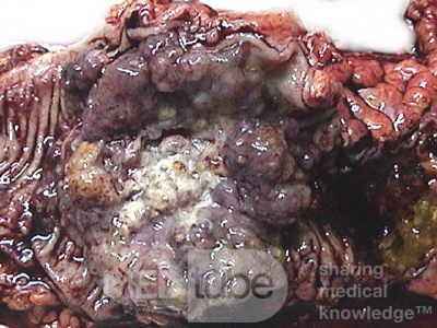 Colon Adenocarcinoma, Villous Adenocarcinoma (6 of 12)