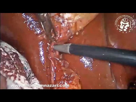 Management of Laparoscopic Trocar Injuries to Anterior Abdominal Wall Blood Vessels
