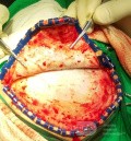 Acute Spontaneous Subdural Hemorrhage in the Subdural Space