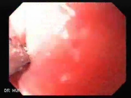 Squamous cell carcinoma of the larynx (2 of 4)