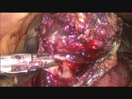 Laparoscopic Resection of a Large Gastric GIST