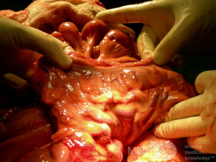 Thickened Mesentery Of The Ileum