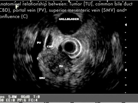 EUS radial scanning of pancreatic cacrinoma