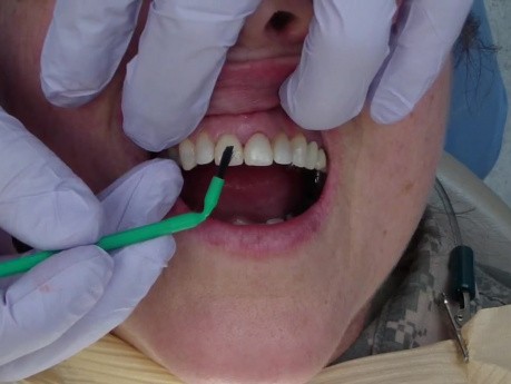 Central Incisor Mockup W: Flowable