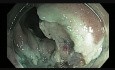 Colonoscopy - Ascending Colon Giant Polyp Resection - step 3 hot biopsy