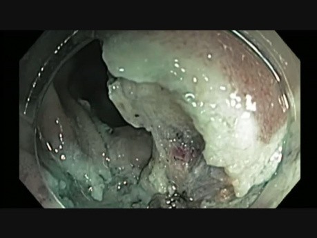 Colonoscopy - Ascending Colon Giant Polyp Resection - step 3 hot biopsy