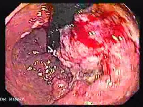 Rectal Adenocarcinoma (3 of 12)
