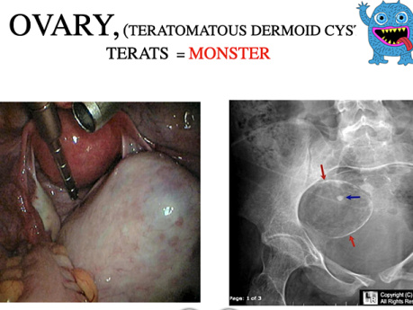 Pediatric Surgery - Common Pediatric Surgical Disorders