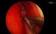 FESS Left Side Polyps