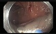 Colonoscopy - Ascending Colon Flat Lesion EMR