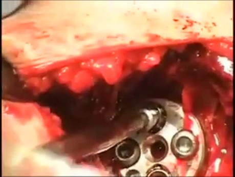 Shoulder Arthroplasty