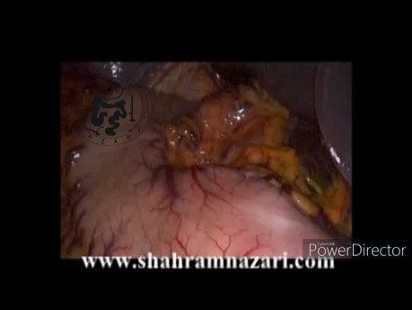 Left Sided Gallbladder in Case of Situs Inversus Totalis