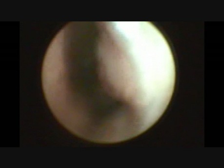 Endoscopic Postnasal Mass Biopsy Under Local Anesthesia