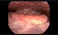 Right Vocal Fold Cyst