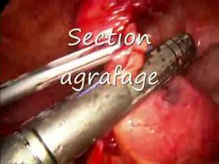 Laparoscopic Management Of Meckel's Diverticulum