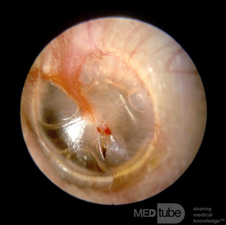 Myringotomy
