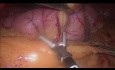 Laparoscopic Sleeve Gastrectomy