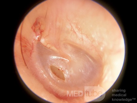 Myringotomy