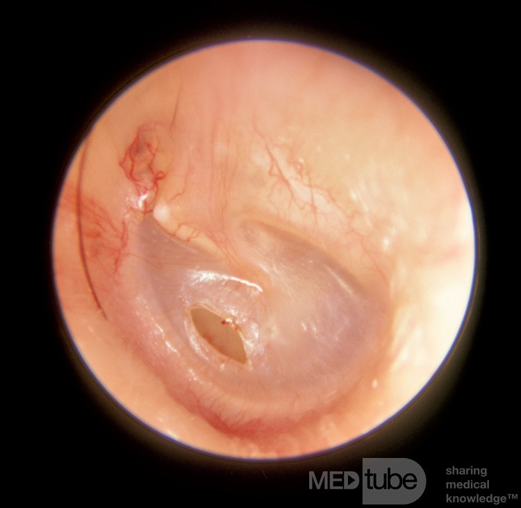 Myringotomy
