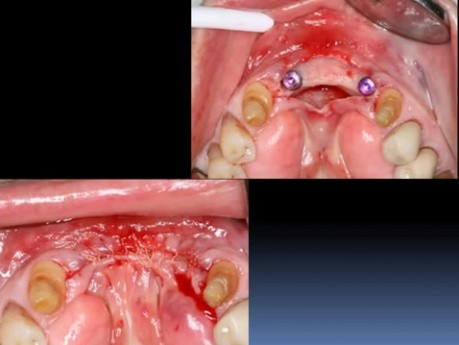 Mandibular Anterior Teeth Replacement With Implant Bridge