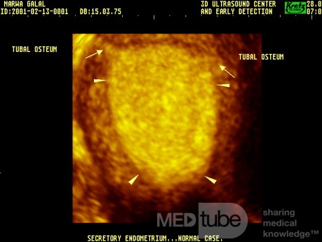 Secretory Endometrium By Three Dimention Us