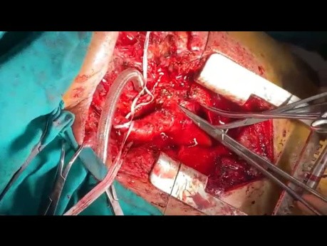 How to Perform Complete Laryngeal Resection with Extensive Invasions to Aortic Arch and 3VD