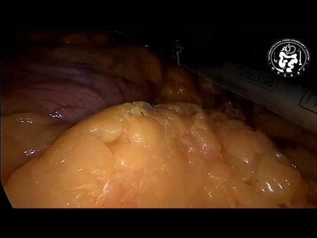 Laparoscopic Sleeve Gastrectomy