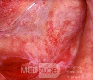 Erythroplakia [floor of mouth]