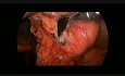 Laparoscopic Resection of Gastric GIST