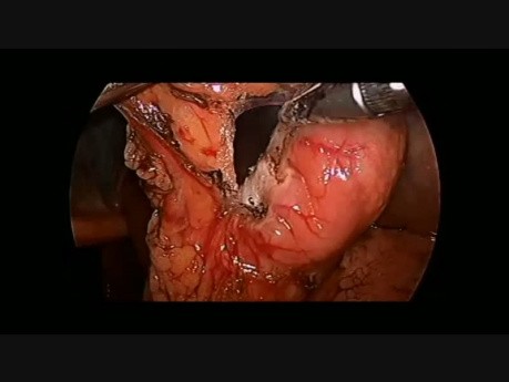 Laparoscopic Resection of Gastric GIST