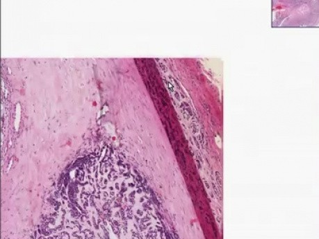 Adenoid cystic carcinoma - Histopathology - Salivary gland
