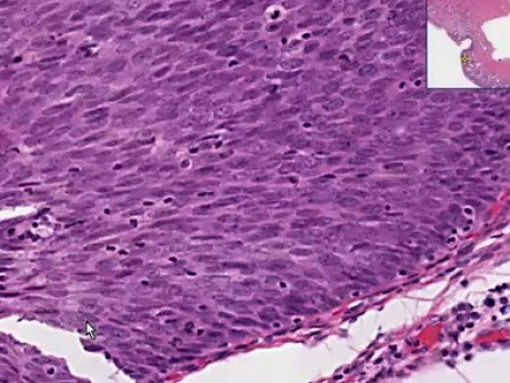 Squamous metaplasia And carcinoma - Histopathology - Cervix