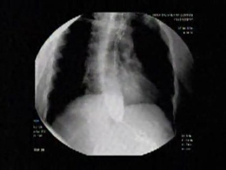 Esophageal Achalasia (6 of 10)