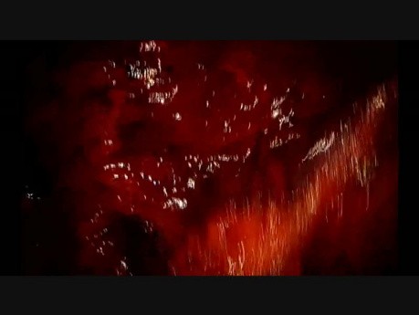 Non Intubated Uniportal VATS Complex Left Upper Lingulectomy (Live Surgery)