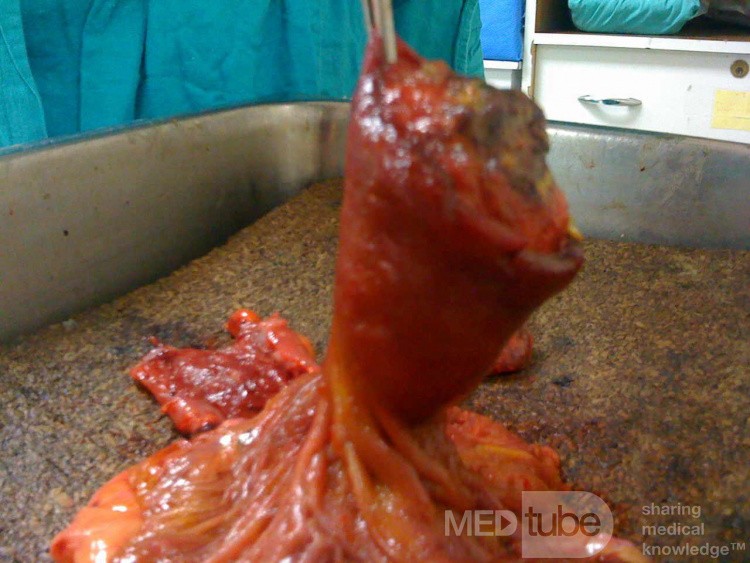 Ascending Colon Intussusception due to a Adenocarcinoma (1 of 6)