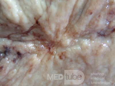 Small Gastric Adenocarcinoma of the Diffuse Ring Cell (15 of 19)