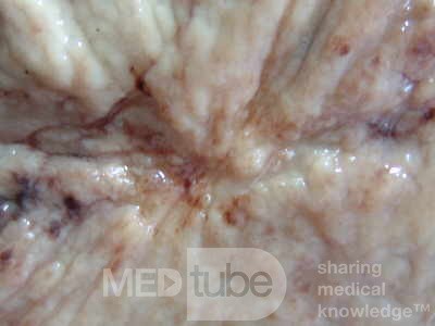 Small Gastric Adenocarcinoma of the Diffuse Ring Cell (15 of 19)