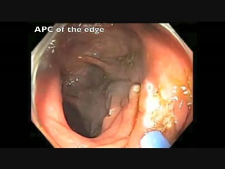 A Snare Resection Of Sessile Polyp in Ascending Colon
