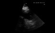 Echocardiography Quiz. Any Abnormality in the Systolic Function of the Left Ventricle
