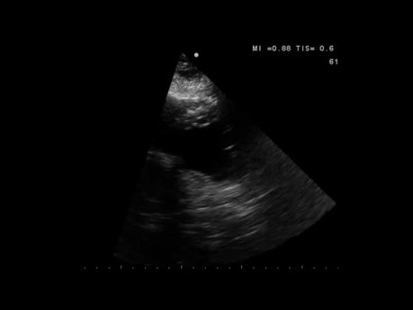 Echocardiography Quiz. Any Abnormality in the Systolic Function of the Left Ventricle