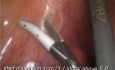 Laparoscopic Sigmoidectomy for Cancer, Oncological Approach 