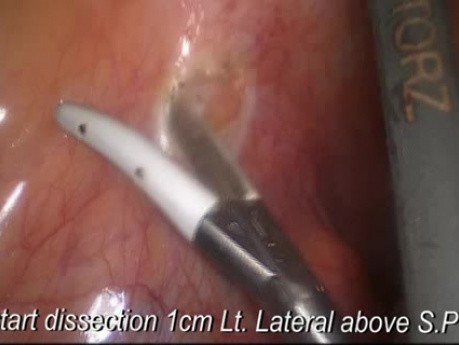 Laparoscopic Sigmoidectomy for Cancer, Oncological Approach 