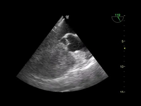 A Rare Case (Quiz) of Transesophageal Echocardiography (Tee Ortoe) and Review of Some Basic Views