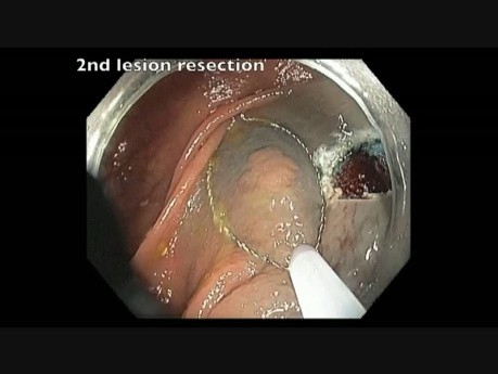 Transverse Colon - Flat Lesion - EMR