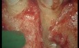 Complicated Tooth Root Fracture