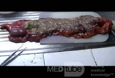 Endoscopic Image of Adenocarcinoma of the Transverse Colon (7 of 9)