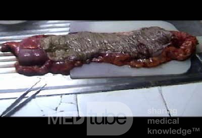 Endoscopic Image of Adenocarcinoma of the Transverse Colon (7 of 9)